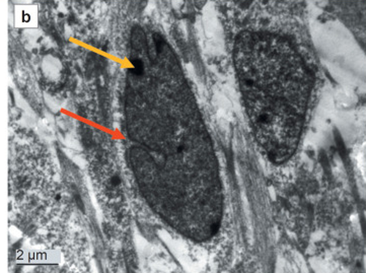 Panel of a six-part figure, cropped to this panel and otherwise unaltered, which CC BY allows with attribution. Human astrocyte differentiated from induced pluripotent stem cells of a healthy donor, 25 days in vitro. The authors describe it as a typical cell nucleus with an eccentrically located nucleolus, marked by the yellow arrow, and shallow invaginations of the envelope, marked by the red arrow. Scale bar 2 micrometres. The invaginations are worth noticing: the envelope drawn as a smooth sphere on most diagrams is not smooth here.